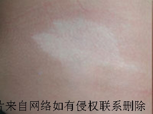 白癜风患者怎么情绪调节